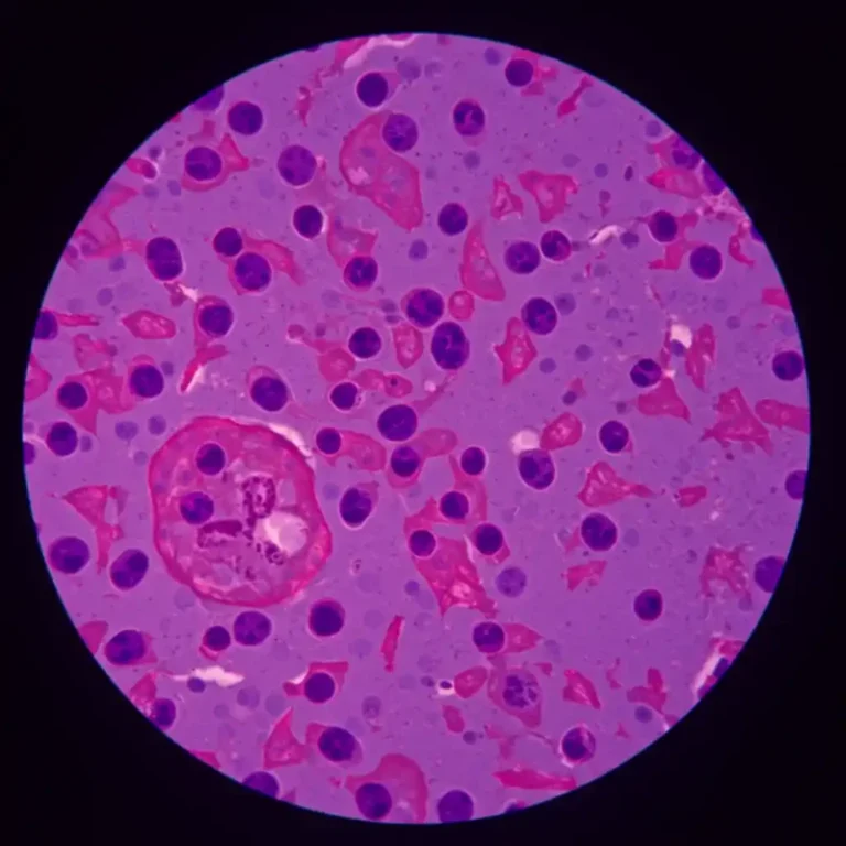 연부조직 육종 진단 및 치료 전략