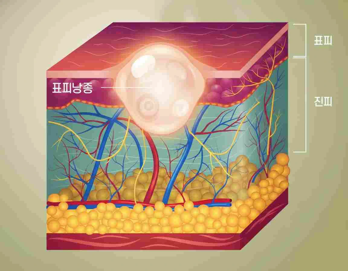 혹처럼 보이지만 원인이 다르다